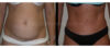 Tummy Tuck case #26623 slider thumbnail