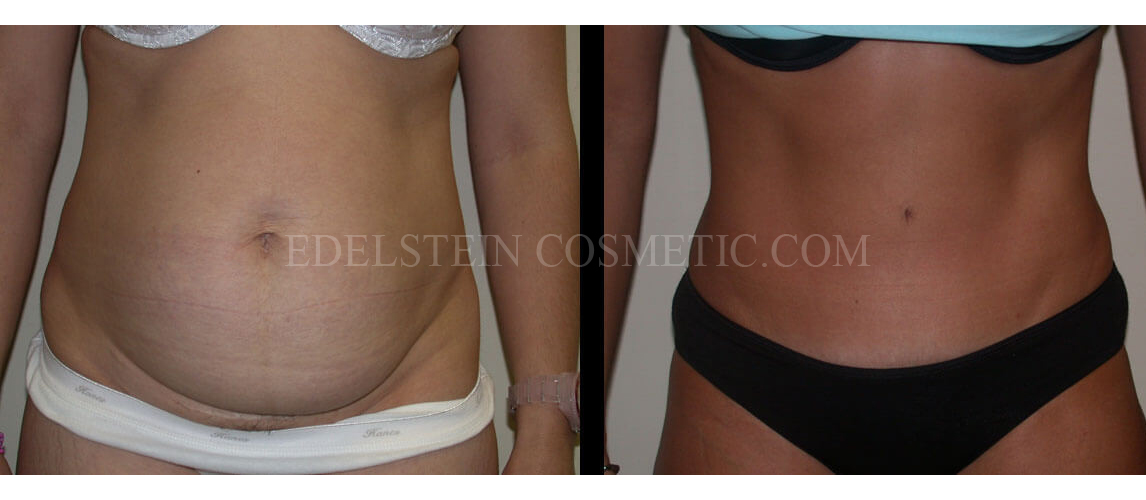 Tummy Tuck case #26623