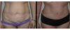 Tummy Tuck case #26622 slider thumbnail