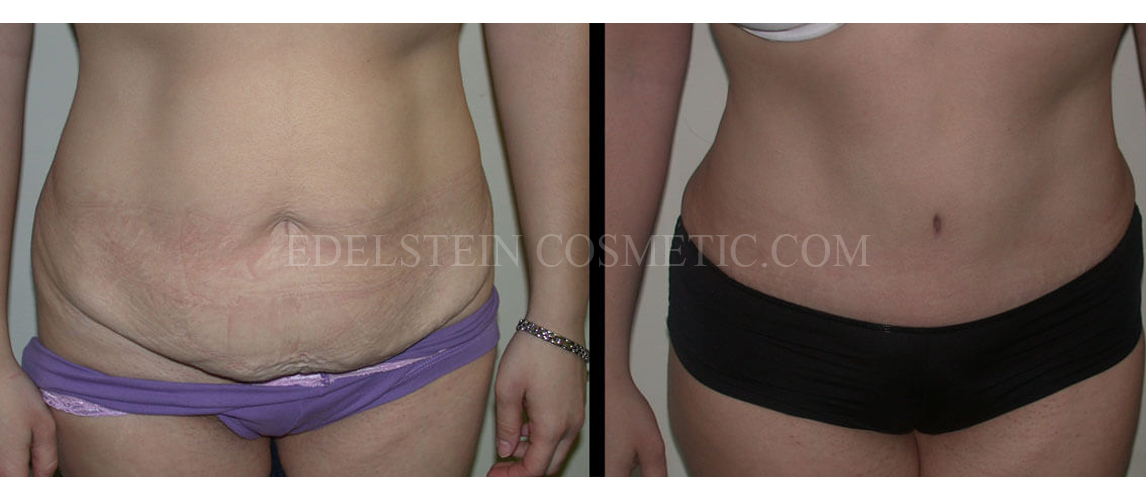 Tummy Tuck case #26622