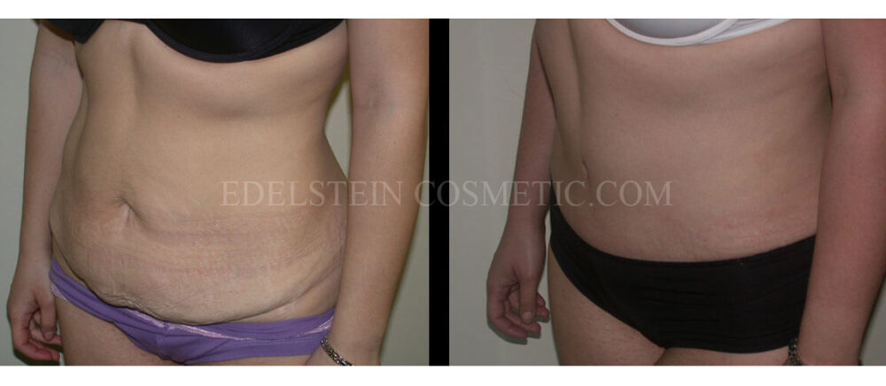 Tummy Tuck case #26622