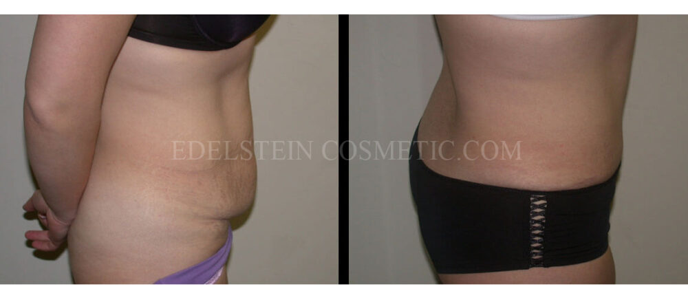 Tummy Tuck case #26622