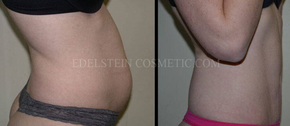 Tummy Tuck case #26621