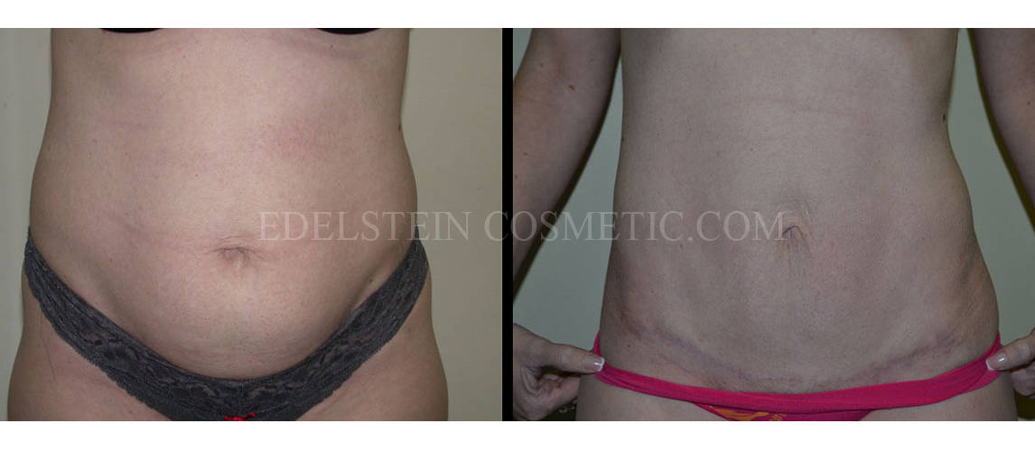 Tummy Tuck case #26621