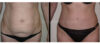 Tummy Tuck case #26620 slider thumbnail