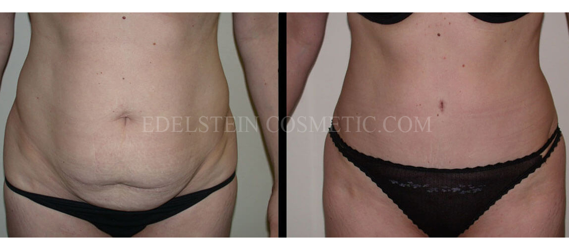 Tummy Tuck case #26620