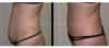 Tummy Tuck case #26620 slider thumbnail