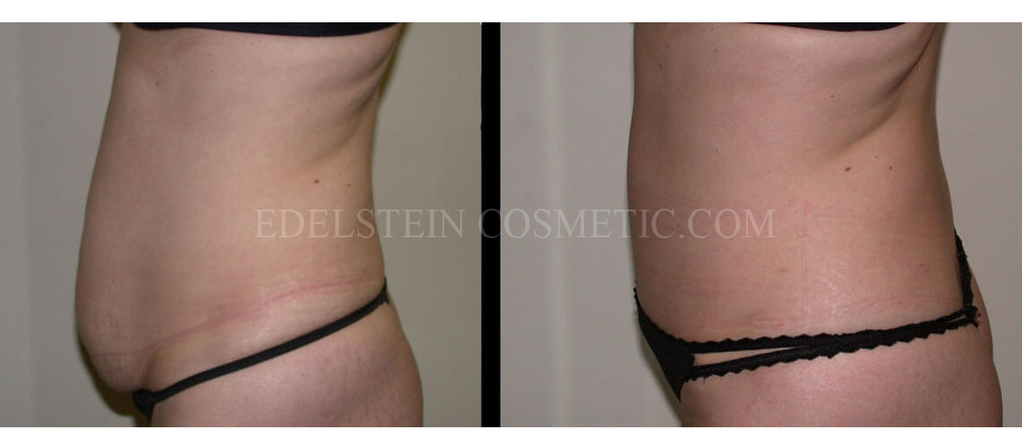 Tummy Tuck case #26620