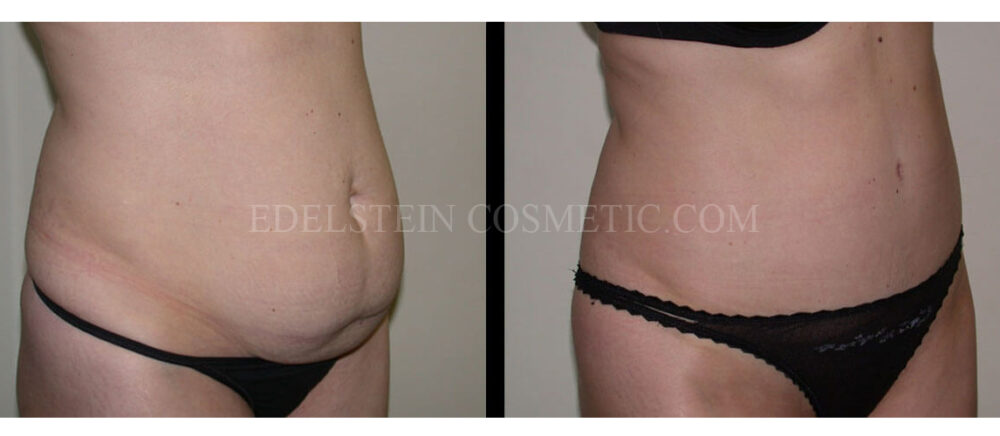 Tummy Tuck case #26620