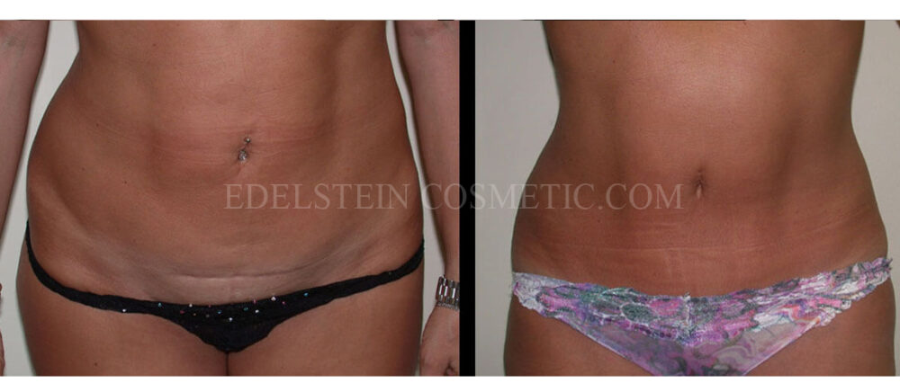 Tummy Tuck case #26619