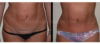 Tummy Tuck case #26619 slider thumbnail