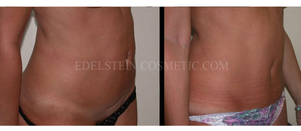 Tummy Tuck case #26619