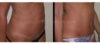 Tummy Tuck case #26619 slider thumbnail