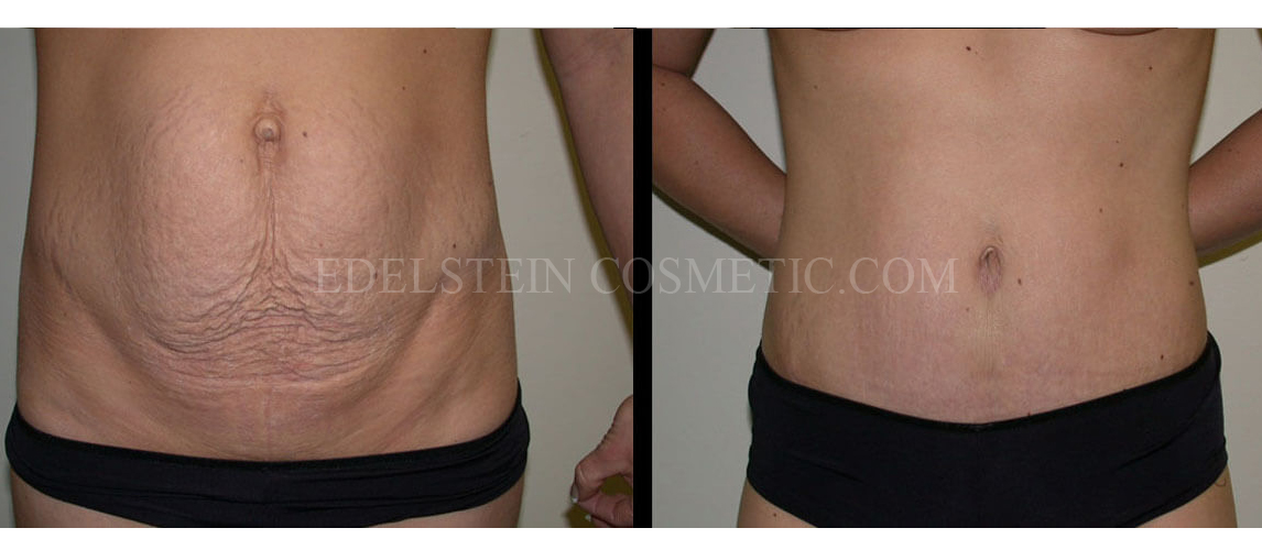 Tummy Tuck case #26618