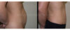 Tummy Tuck case #26618 slider thumbnail