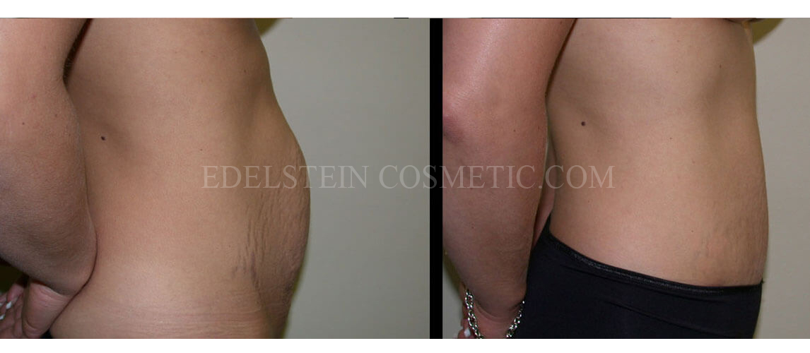 Tummy Tuck case #26618