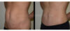 Tummy Tuck case #26618 slider thumbnail