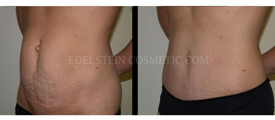 Tummy Tuck case #26618