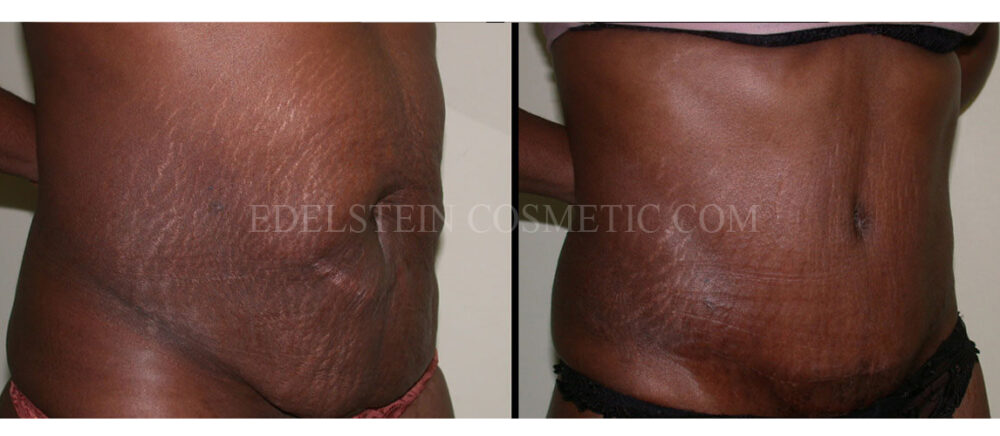 Tummy Tuck case #26617