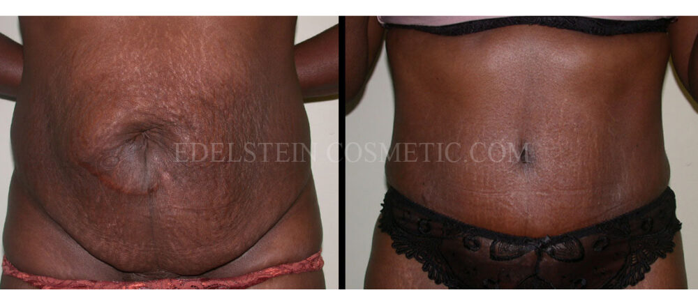 Tummy Tuck case #26617