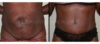 Tummy Tuck case #26617 slider thumbnail