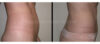 Tummy Tuck case #26616 slider thumbnail