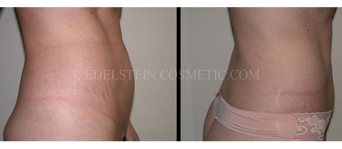 Tummy Tuck case #26616