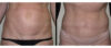 Tummy Tuck case #26616 slider thumbnail