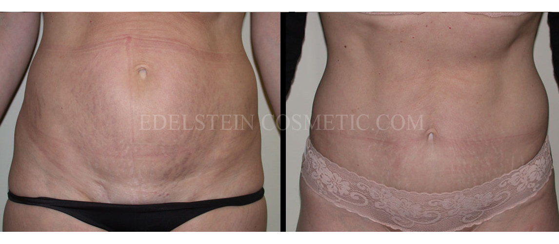 Tummy Tuck case #26616