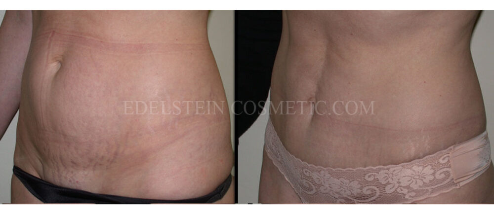 Tummy Tuck case #26616