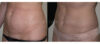 Tummy Tuck case #26616 slider thumbnail