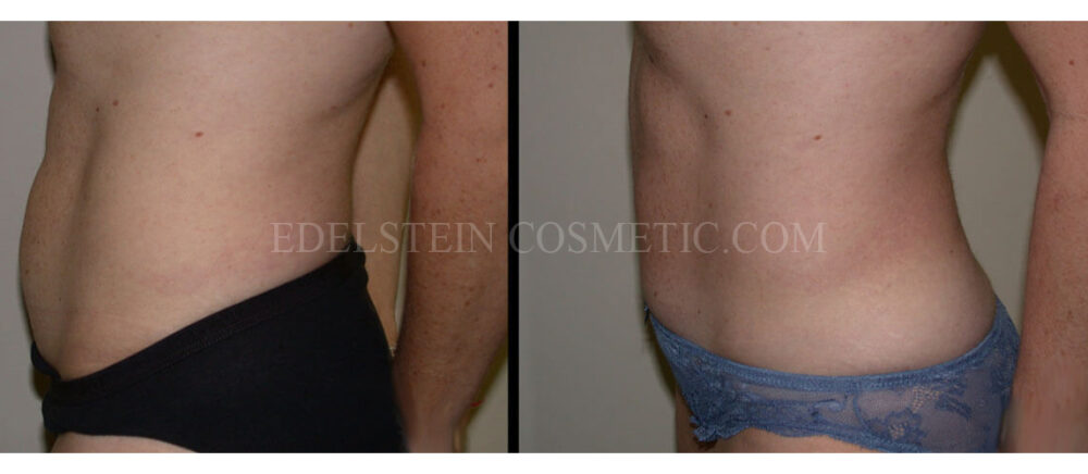 Tummy Tuck case #26615