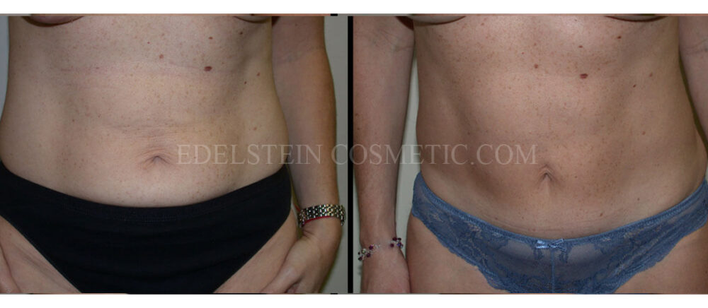 Tummy Tuck case #26615