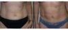 Tummy Tuck case #26615 slider thumbnail