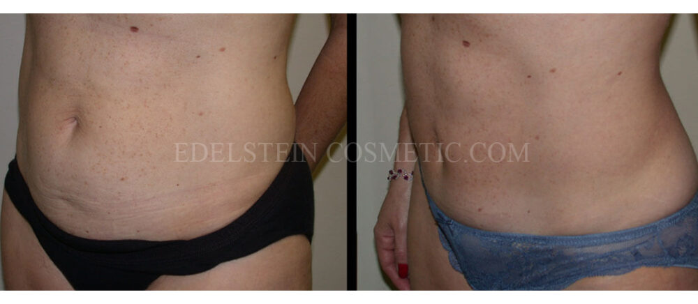 Tummy Tuck case #26615