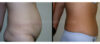 Tummy Tuck case #26614 slider thumbnail