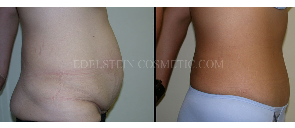 Tummy Tuck case #26614