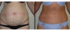 Tummy Tuck case #26614 slider thumbnail