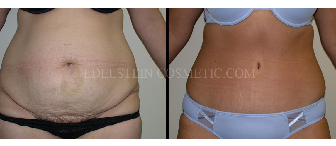 Tummy Tuck case #26614