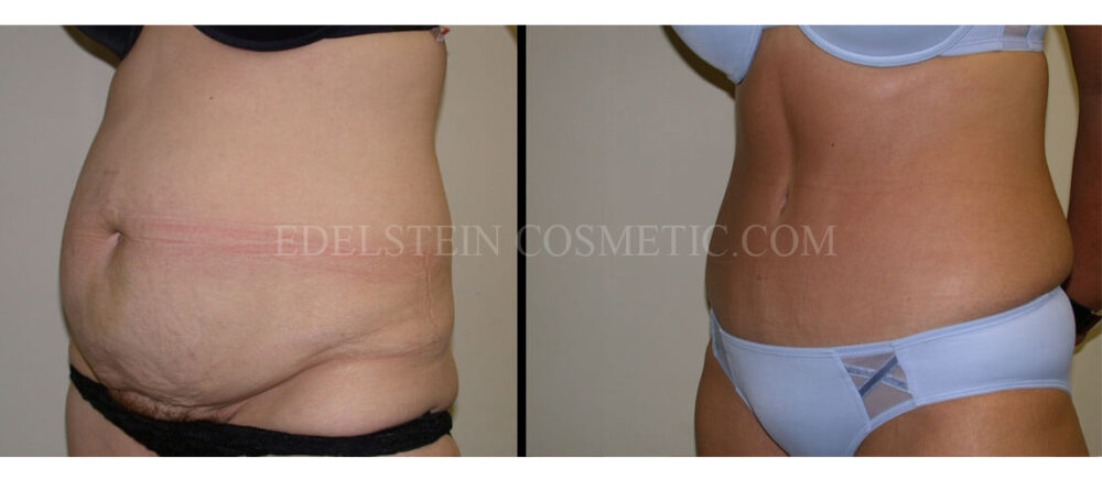 Tummy Tuck case #26614