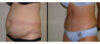 Tummy Tuck case #26614 slider thumbnail