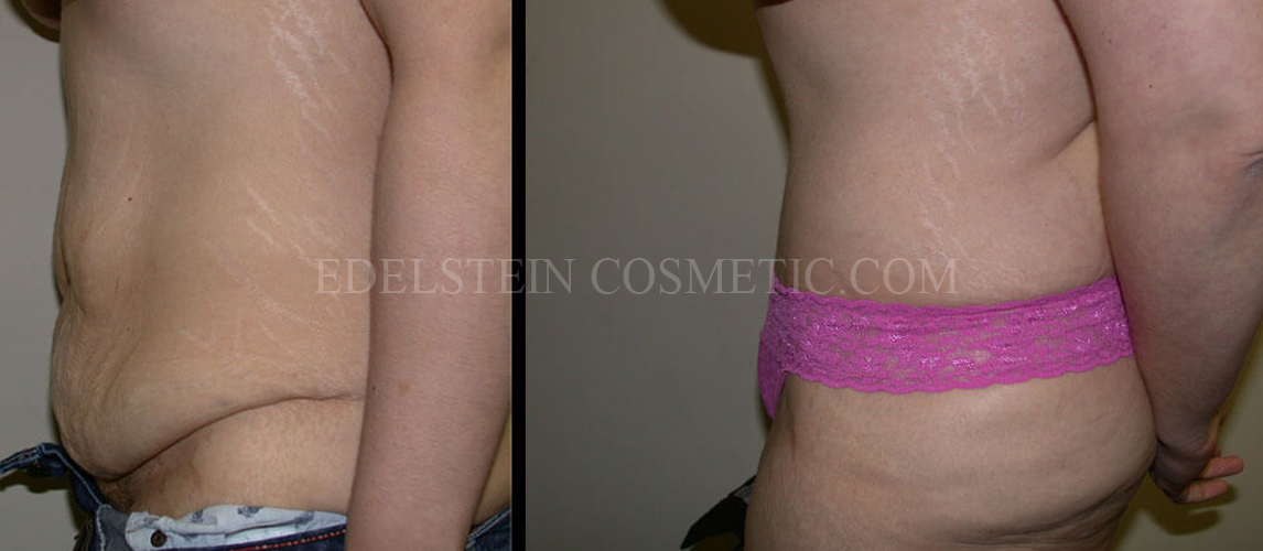 Tummy Tuck case #26613