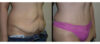 Tummy Tuck case #26613 slider thumbnail