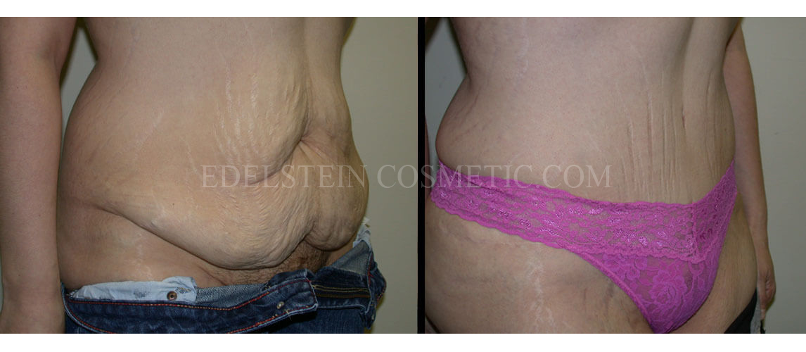 Tummy Tuck case #26613