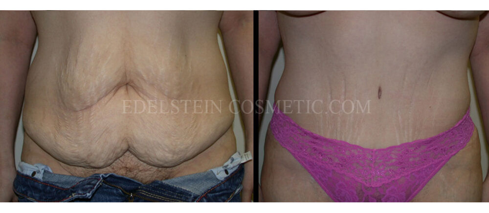 Tummy Tuck case #26613