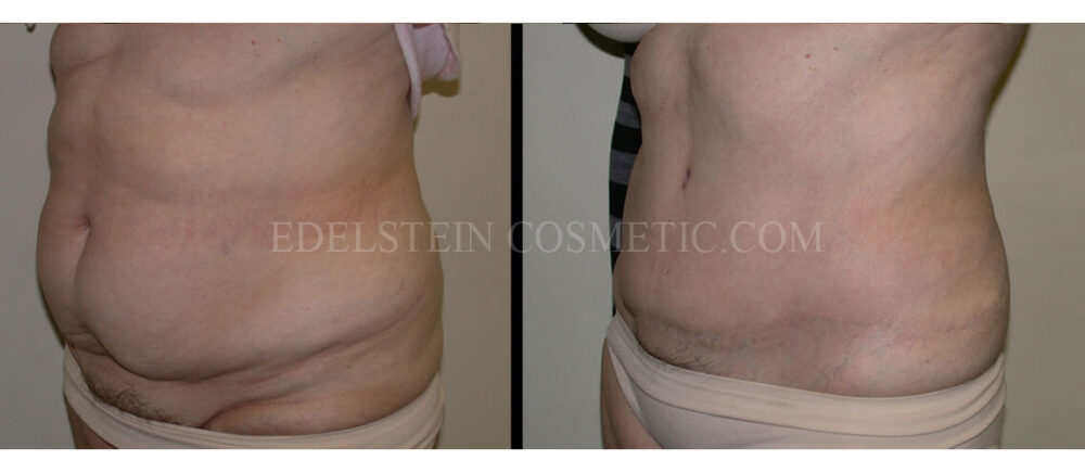 Tummy Tuck case #26612