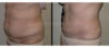 Tummy Tuck case #26612 slider thumbnail