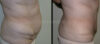 Tummy Tuck case #26612 slider thumbnail