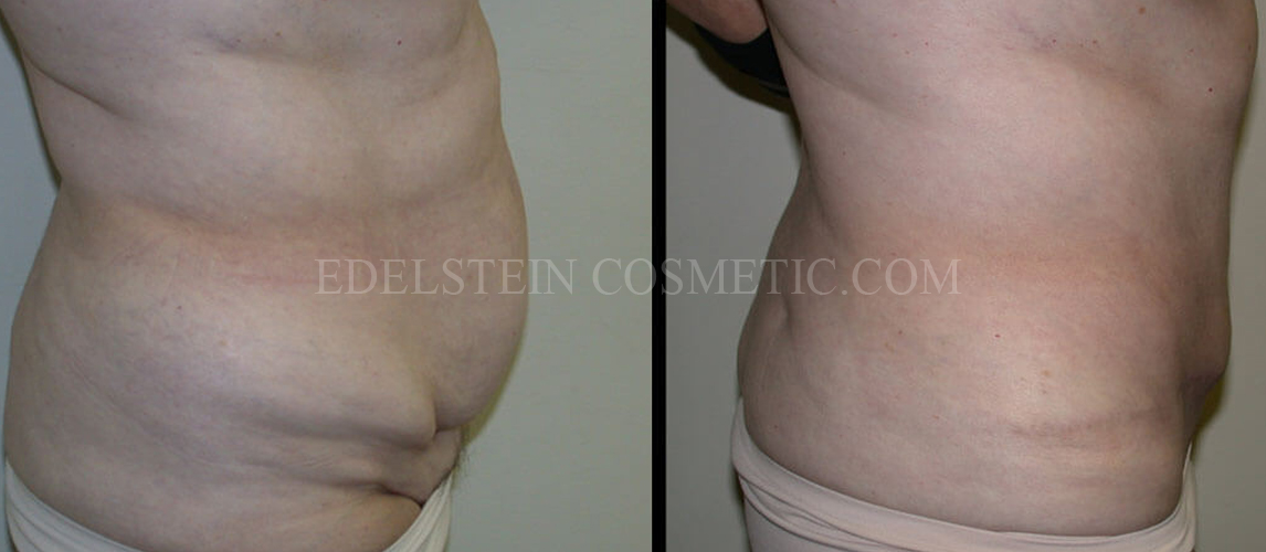 Tummy Tuck case #26612