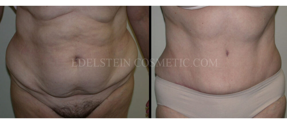 Tummy Tuck case #26612